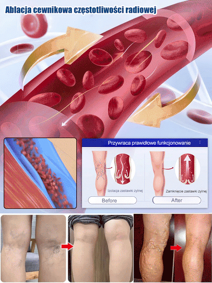 Spray do leczenia żył nóg