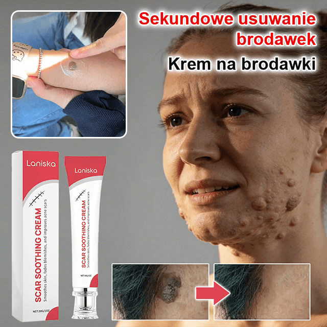 【Jednosekundowy usuwacz brodawek】Krem do usuwania brodawek