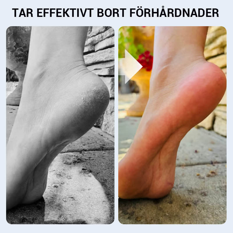 🔥 ﻿Praktyczny ręczny przyrząd do usuwania zrogowaciałego naskórka ze stóp🦶🏻